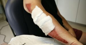 Common Injuries Sustained in Motorcycle Accidents
