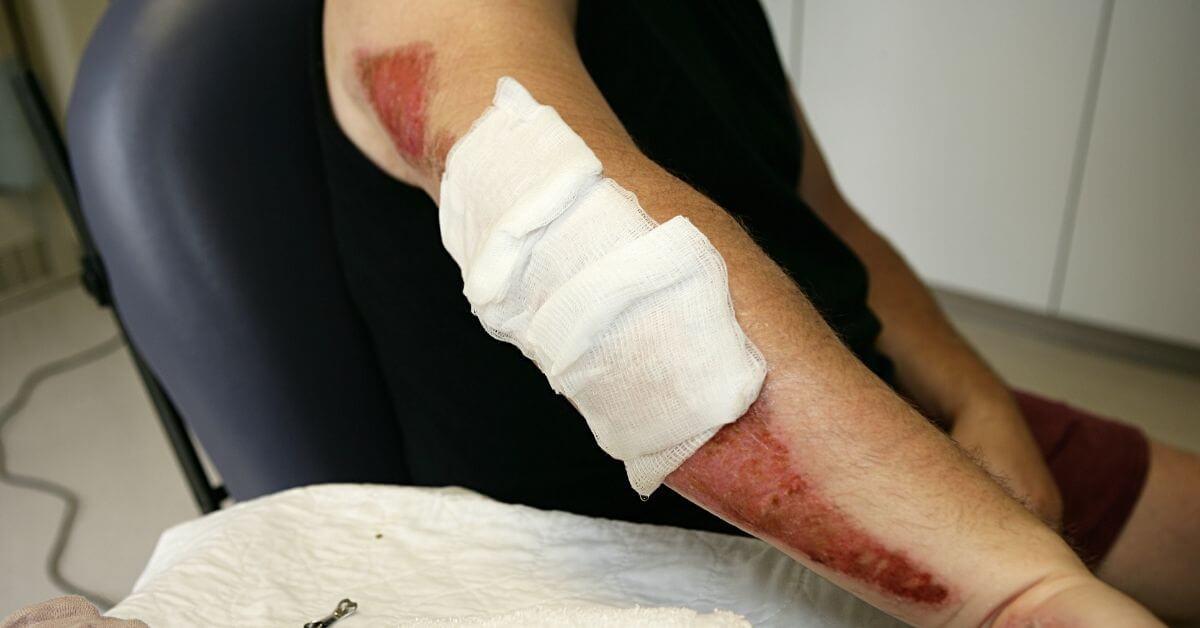 Common Injuries Sustained in Motorcycle Accidents